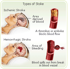 What are the symptoms of an acute stroke?